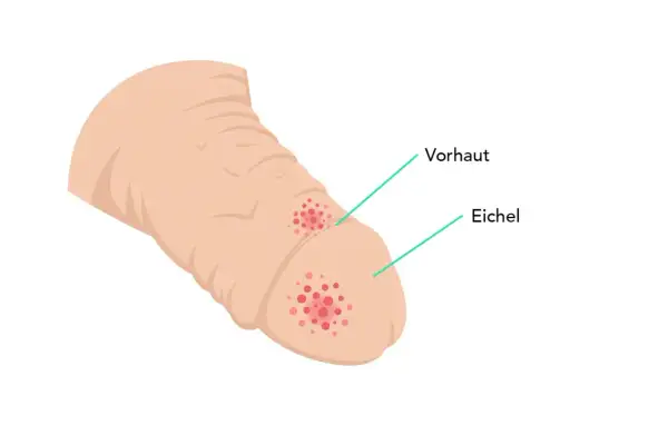 Illustration zeigt einen Penis mit roten Flecken auf der Eichel und Vorhaut, die auf einen möglichen tumor am penis hinweisen könnten.