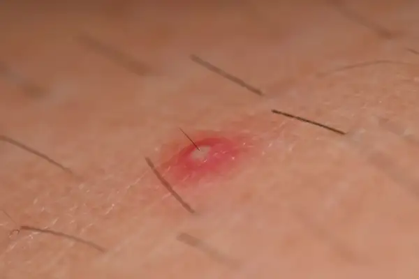 Widoczne pryszcze na karku, z widocznym włosem przebijającym przez jeden z nich. Skóra jest zaczerwieniona i lekko podrażniona.