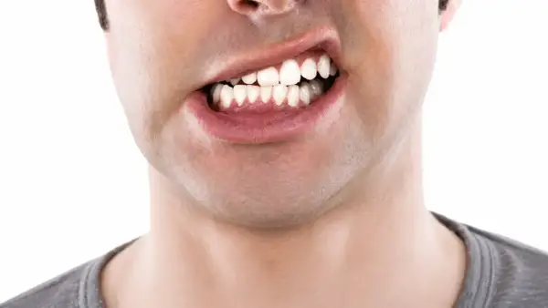 Primo piano di un uomo con denti visibili, che mostra una possibile malocclusione dentale adulti.