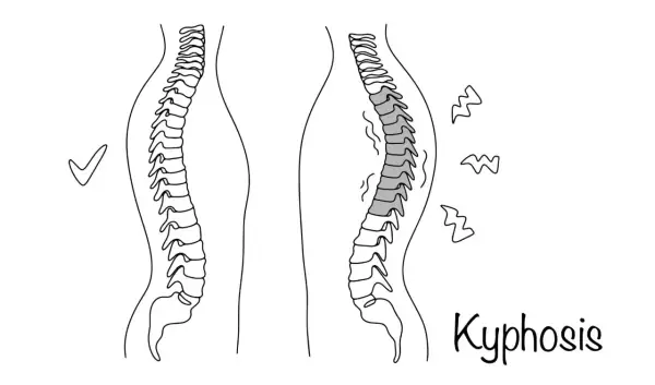 Confronto tra colonna vertebrale sana e cifosi. La cifosi causa posture curve, rendendo le persone gobbe.