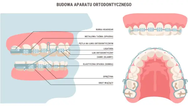 Aparat ortodontyczny: Kiedy zacząć i jakie warunki musisz spełnić?