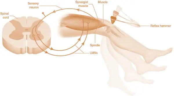Schema del riflesso patellare. Un martelletto colpisce il ginocchio, causando un'estensione rapida dovuta all'ipertonia muscolare.