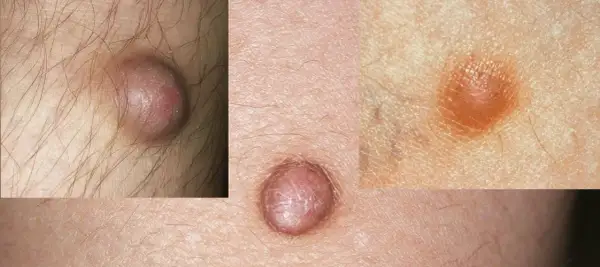 Nahaufnahme von Hautveränderungen, die auf fibrose Hautbilder hinweisen. Kleine, erhabene Knötchen auf der Haut.
