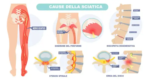 Illustrazione delle cause della sciatica: sindrome del piriforme, discopatia degenerativa, stenosi spinale ed ernia del disco che comprimono il nervo sciatico.