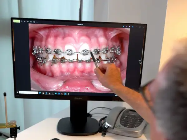 Primo piano di un monitor che mostra un'immagine ravvicinata di denti con apparecchio fisso. Una mano indica l'immagine.