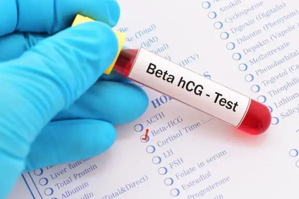 Ręka w niebieskiej rękawiczce trzyma probówkę z krwią do testu Beta hCG. Czerwony znaczek obok "Beta-HCG" sugeruje, że badanie jest wykonywane, aby sprawdzić, dlaczego beta hcg spada.