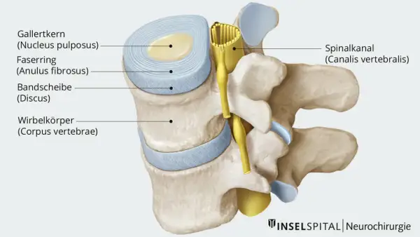 Querschnitt einer Bandscheibe mit Gallertkern und Faserring, die auf einen Spinalkanal drückt. Dies zeigt eine breitbasige Bandscheibenprotrusion.