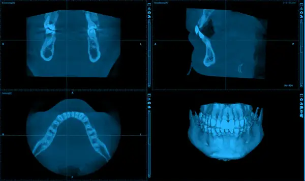 Trzy widoki tomografii komputerowej szczęki i żuchwy. Widok osiowy pokazuje łuk zębowy. Ile kanałów ma 7 zębów? To pytanie dla dentysty.