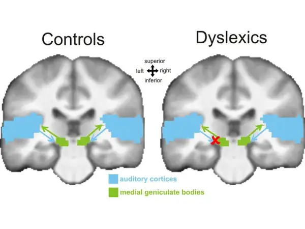 Czy dysleksja to choroba? Prawda o zaburzeniu neurorozwojowym
