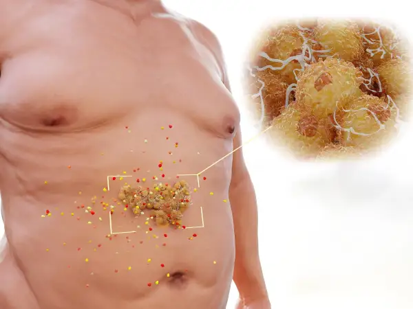 Addome con accumuli di grasso viscerale, ingrandimento di cellule adipose. Obiettivo: eliminare grasso viscerale.