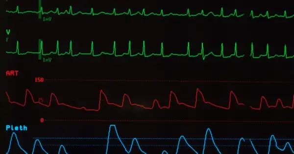 Monitor EKG pokazuje nieregularne fale, mogące wskazywać na migotanie przedsionków objawy.