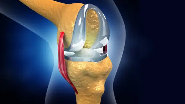 Knieprothese im Detail. Nach einer Meniskus-OP wie lange krank? Rehabilitation ist entscheidend.