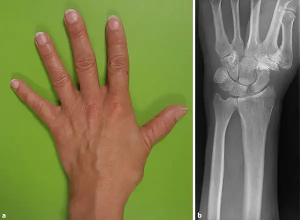 Hand und Röntgenbild des Handgelenks. Der **flexor carpi radialis** ist ein wichtiger Muskel für die Handbewegung.