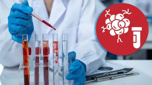 Laborant mit blauen Handschuhen tropft Blut in Reagenzgläser. Symbol für Tumormarker im Blut.