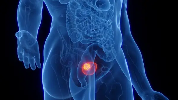 Anatomical illustration showing a tumor within the bladder, symbolizing the progression of umieranie na raka pęcherza.