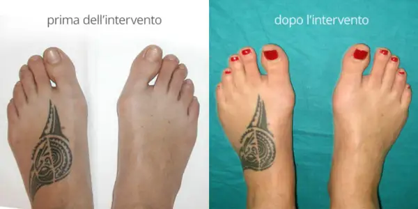 Confronto alluce valgo prima e dopo intervento. Il piede sinistro mostra un evidente alluce valgo, il destro è corretto.