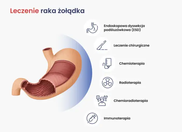 Nowoczesne leczenie raka żołądka obejmuje ESD, chirurgię, chemioterapię, radioterapię, chemioradioterapię i immunoterapię.
