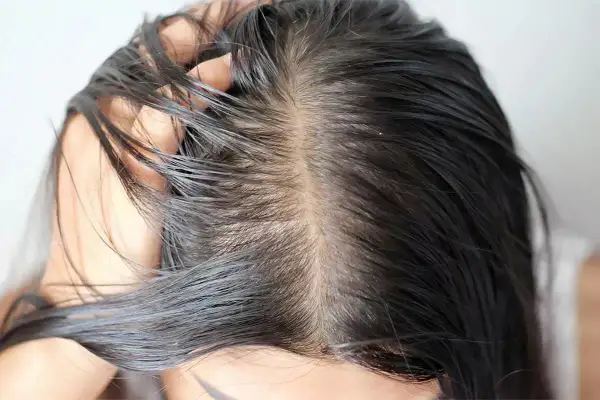 Primer plano del cuero cabelludo de una mujer con pelo graso, mostrando la separación del cabello y el brillo aceitoso.