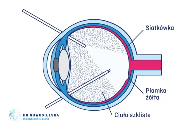 Schemat oka po witrektomii z gazem. Widzenie może być zniekształcone przez bańkę gazu wypełniającą ciało szkliste.