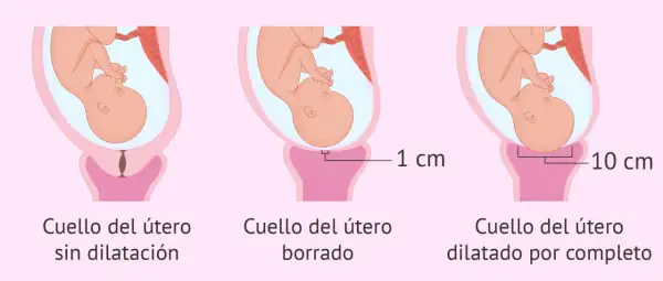 Ilustración muestra la dilatación del cuello uterino durante el parto: sin dilatación, borrado y dilatado por completo (10 cm).