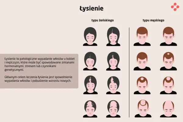 Ilustracja pokazuje różne rodzaje łysienia u kobiet i mężczyzn, od początkowych etapów po zaawansowane.