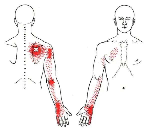 Dolor serrato posterior superior: Alivio y prevención efectiva
