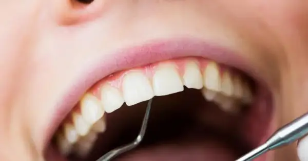 Usta z widocznym małym ubytkiem w zębie, badane narzędziem dentystycznym.