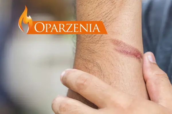 Oparzenia na przedramieniu. Zobacz, co na oparzenia pomoże.