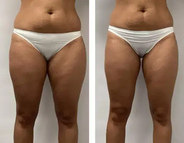 Endermologia: Kiedy efekty? Po 3 sesjach już widać! Pełna przemiana