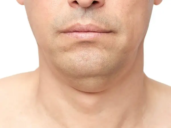 Primer plano de la barbilla y el cuello de un hombre, mostrando papada. Una imagen que ilustra cómo adelgazar la cara.