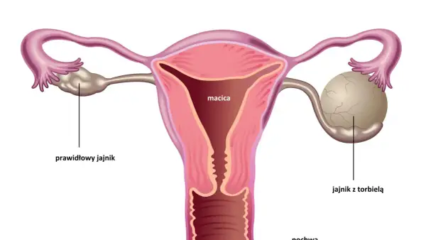 Anatomical illustration showing a uterus, fallopian tubes, and ovaries. One ovary is normal, the other has a cyst. This visual helps understand torbiel na jajniku objawy.