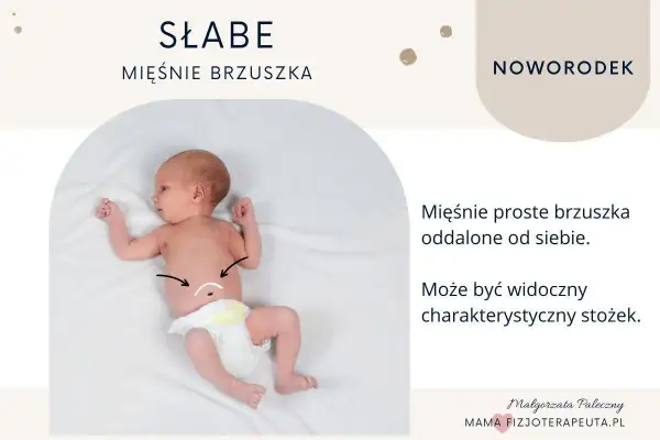 Noworodek z widocznym rozejściem mięśni brzucha, zaznaczonym na brzuszku.