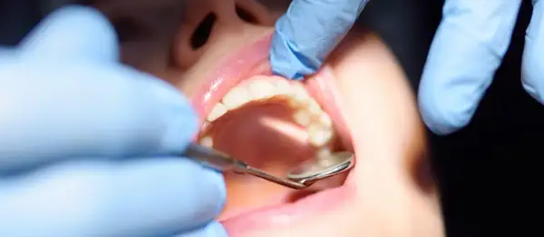 Dentysta bada zęby, szukając oznak próchnicy wtórnej.