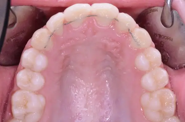 Filo contenzione denti: un sottile filo metallico applicato dietro gli incisivi per mantenere l'allineamento. Il costo varia.