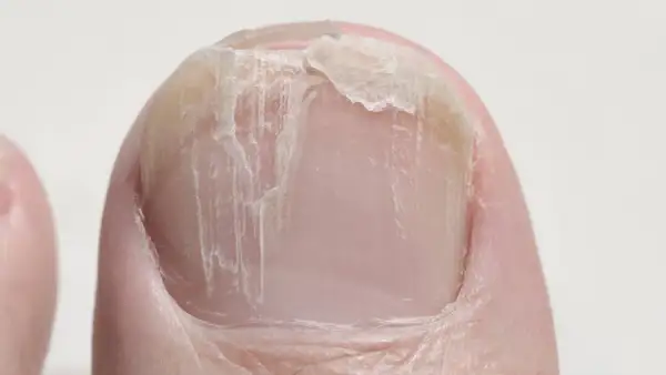 Nahaufnahme eines Zehennagels mit querrillen und abgebrochenen Stellen.
