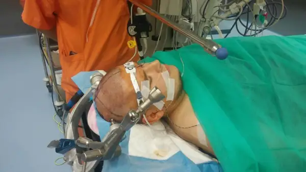 Pacjent przygotowany do operacji guza mózgu. Widoczny fragment głowy z zaznaczeniami i aparatura medyczna.