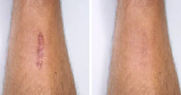 Przed i po: widoczne laserowe usuwanie blizn efekty. Blizna na ramieniu stała się znacznie mniej widoczna.