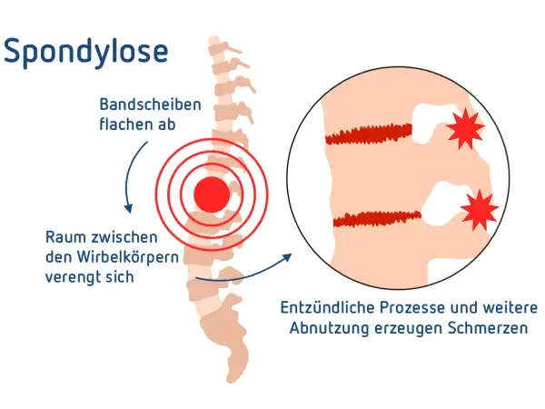 Spondylose LWS: Bandscheiben flachen ab, Raum zwischen Wirbelkörpern verengt sich. Entzündliche Prozesse und Abnutzung erzeugen Schmerzen.