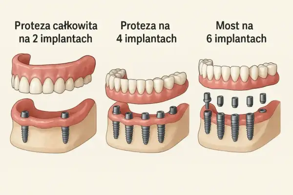 Ilustracja pokazuje trzy rodzaje protez dentystycznych: całkowitą na 2 implantach, na 4 implantach oraz most na 6 implantach.