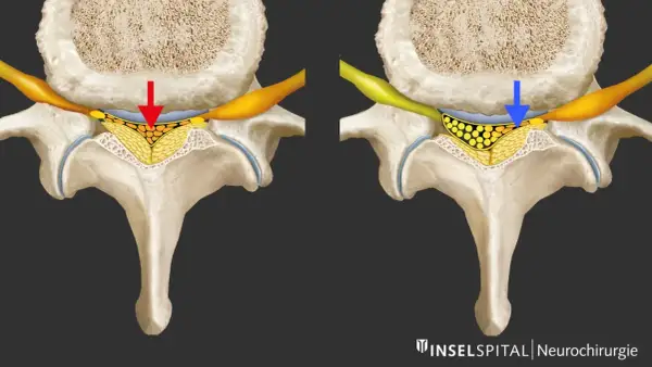 Vergleich: Spinalkanalstenose LWS mit Druck (rot) vs. Entlastung (blau). Die Darstellung zeigt, wie sich die Nervenwurzeln bei einer Spinalkanalstenose LWS verhalten.