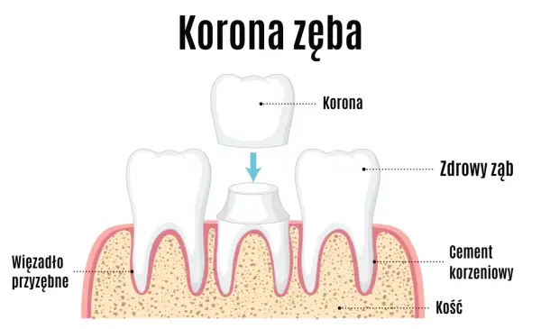 Ilustracja pokazuje proces zakładania korony na ząb. Dwa zdrowe zęby po bokach, a w środku ząb przygotowany do założenia korony, która jest umieszczona nad nim.