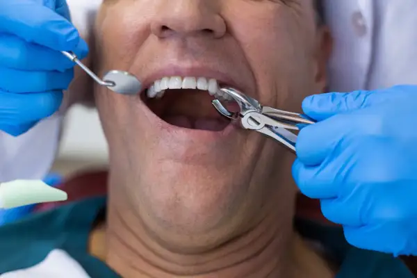 Dentysta w niebieskich rękawiczkach używa kleszczy do ekstrakcji zęba. Pacjent ma otwarte usta, widać jego zęby.