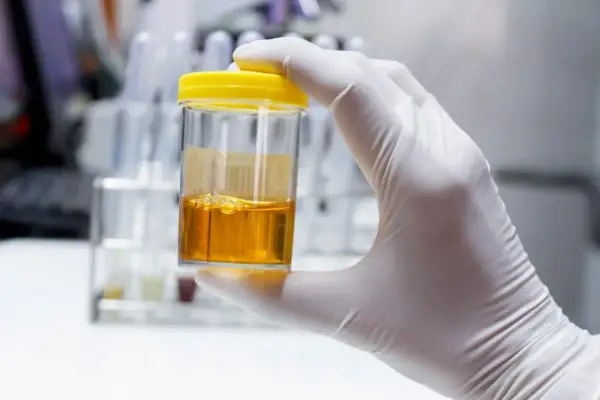 Posiew moczu: precyzyjna diagnoza ZUM. Co wykrywa i jak czytać?
