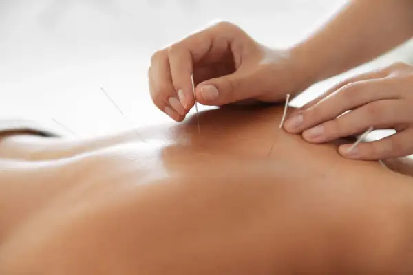 Main d'acupuncteur plaçant des aiguilles sur le dos d'une personne. L'acupuncture effet au bout de combien de temps ?