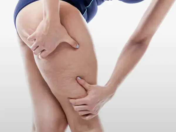 Mani che stringono la coscia, evidenziando la pelle con segni di cellulite, forse un effetto di 10 kg di ritenzione idrica.