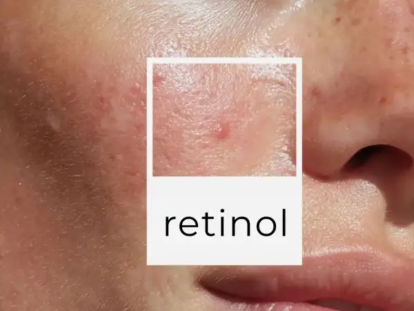 Zbliżenie na skórę z niedoskonałościami, gdzie widać tekst "retinol". To składnik aktywny, który pomaga w walce z trądzikiem i oznakami starzenia.
