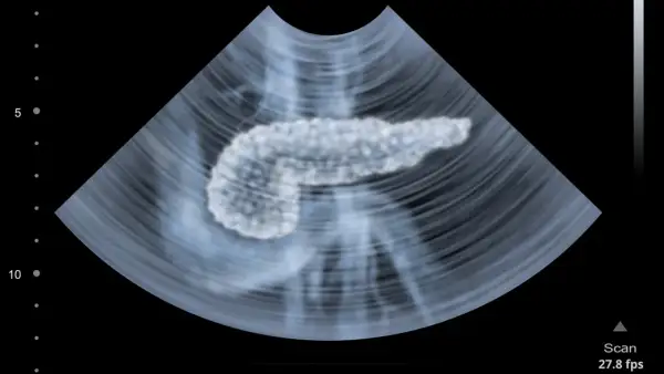 Ultraschallbild einer Bauchspeicheldrüse. Die Pankreas Untersuchung zeigt das Organ in detaillierter Ansicht.