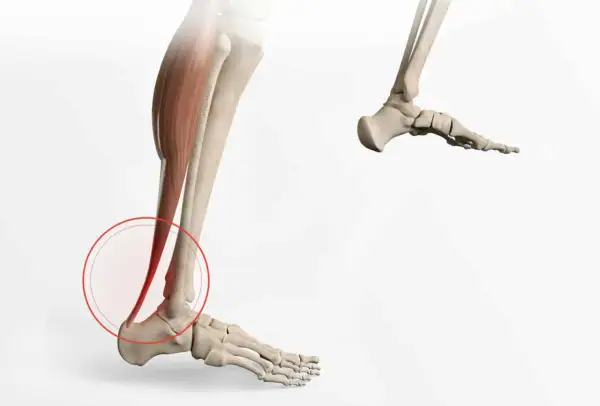 Illustration médicale montrant une calcification du tendon d'Achille, avec une zone rouge entourant la zone affectée.