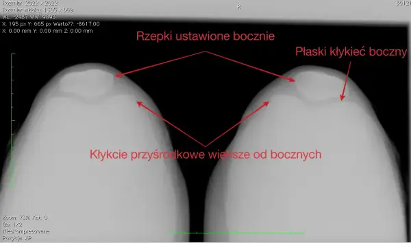 Zwichnięcie rzepki: ile trwa rehabilitacja? Od 4 tyg. do roku
