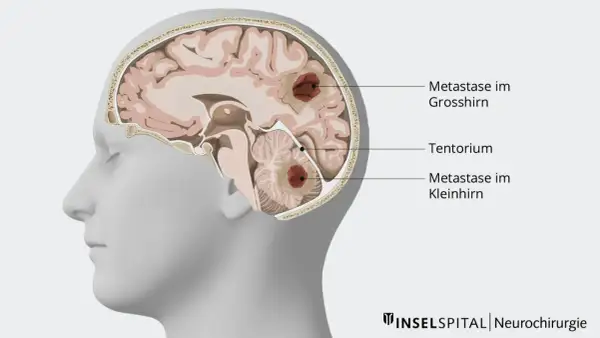 Schnitt durch ein Gehirn mit Metastasen im Großhirn und Kleinhirn. Die Darstellung zeigt, wie Metastasen im Kopf das Leben beeinflussen können.